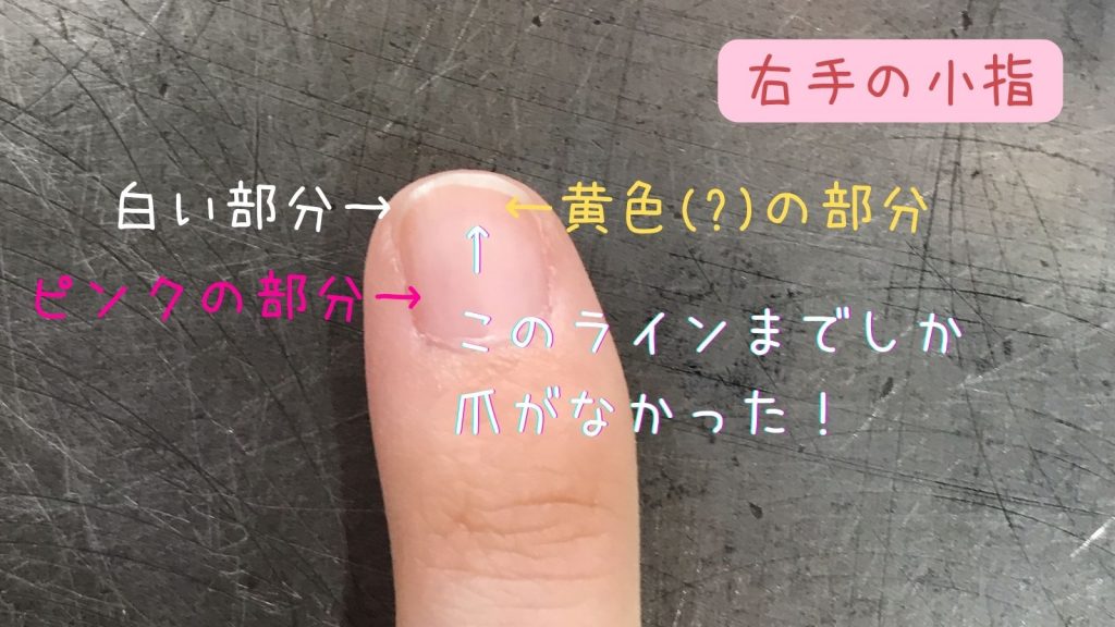 爪を噛む癖がやめられない 深爪女子が深爪卒業を目指すために編み出した爪育成方法とは 株式会社 エー ティ エム